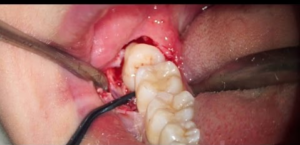 wisdom teeth, extraction
