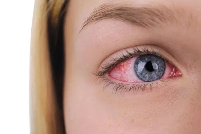 dry eye condition